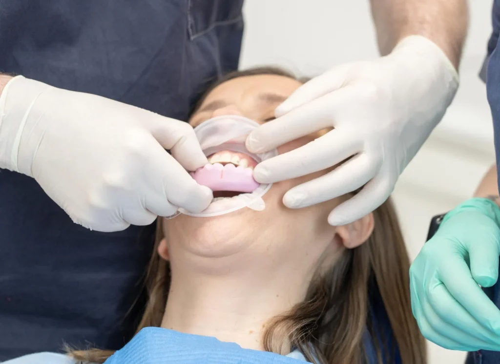Come si mettono le faccette dentali? 1 come si mettono le faccette dentali