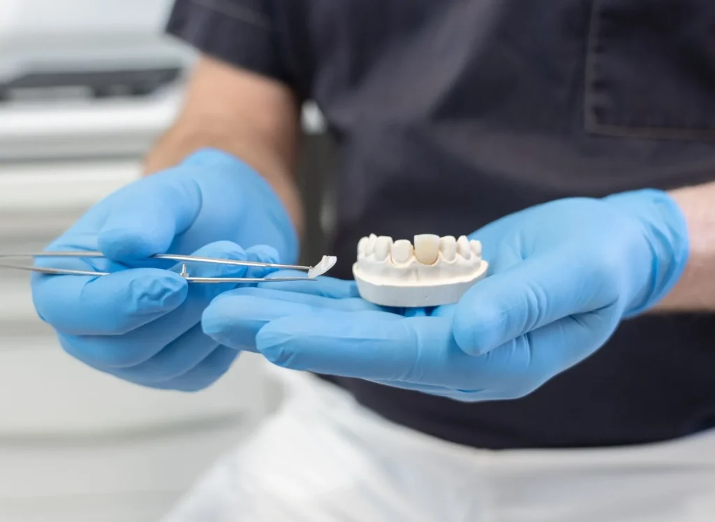 Cosa sono le faccette dentali? 1 cosa sono le faccette dentali