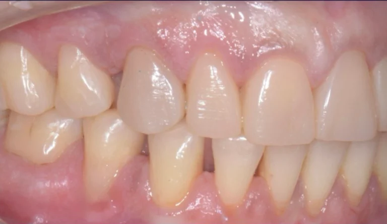 Caso Faccette Dentali 1