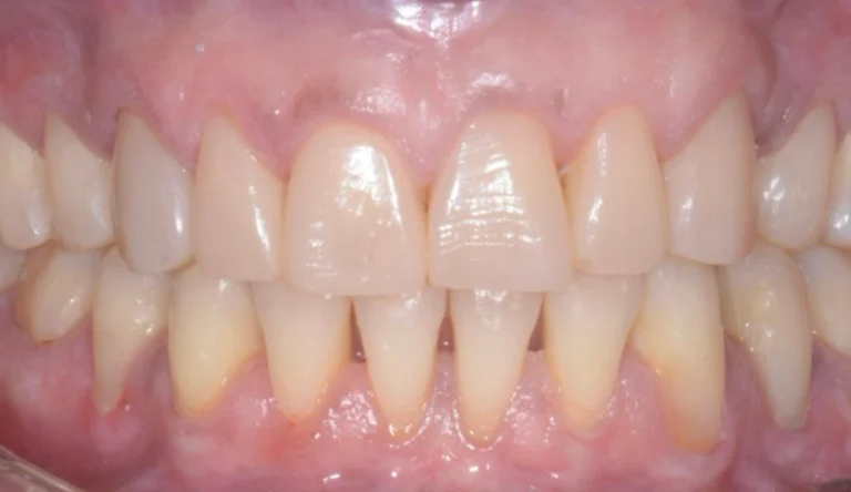 Caso Faccette Dentali 1