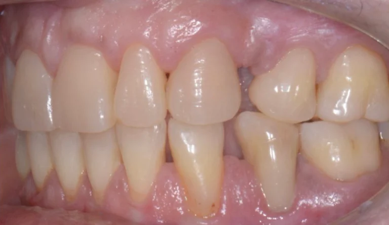 Caso Faccette Dentali 1