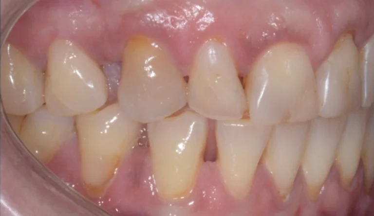 Caso Faccette Dentali 1