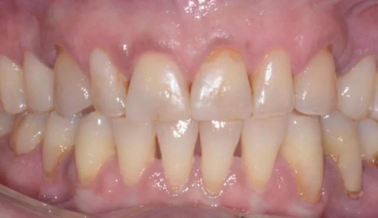 Caso Faccette Dentali 1