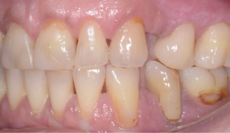 Caso Faccette Dentali 1