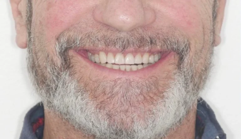 Caso Faccette Dentali 2