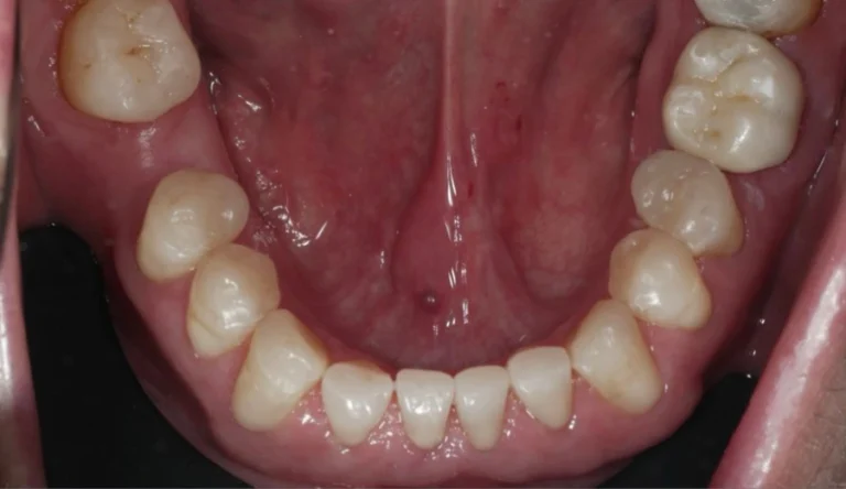 Caso Faccette Dentali 2