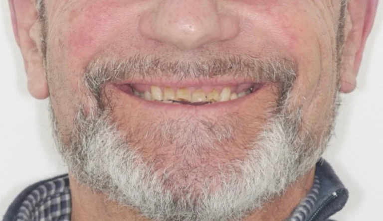 Caso Faccette Dentali 2