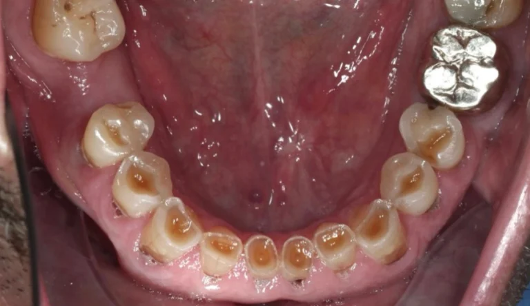 Caso Faccette Dentali 2 - Prima 3