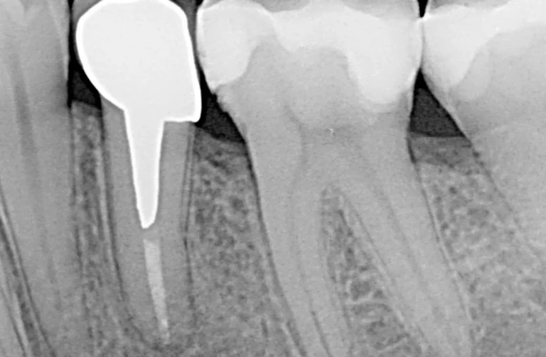 Endodonzia 25 Endodonzia - 1 Dopo