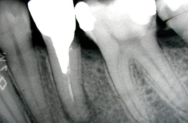 Endodonzia 24 Endodonzia - 1 Prima