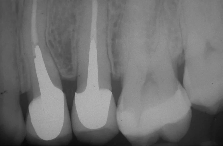Endodonzia 27 Endodonzia - 2 Dopo