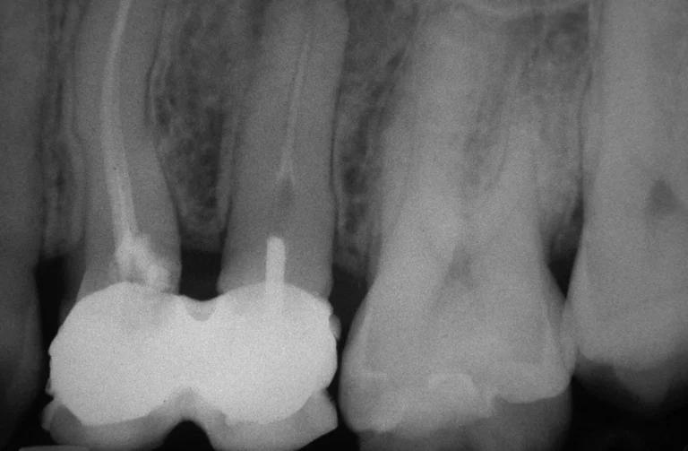 Endodonzia 26 Endodonzia - 2 Prima