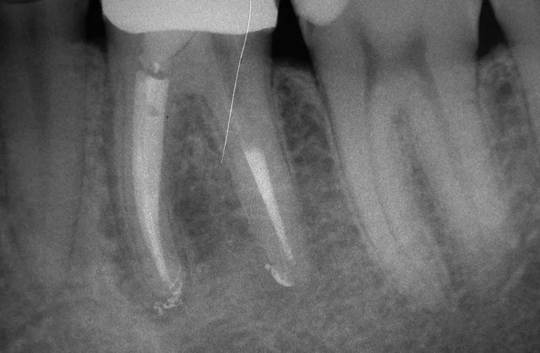 Endodonzia 29 Endodonzia - 3 Dopo