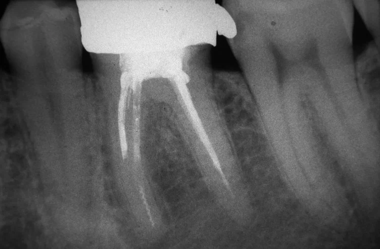 Endodonzia 28 Endodonzia - 3 Prima