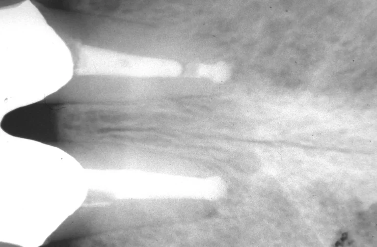 Endodonzia 31 Endodonzia - 4 Dopo