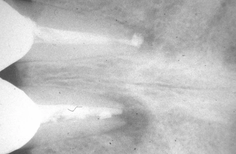 Endodonzia 30 Endodonzia - 4 Prima