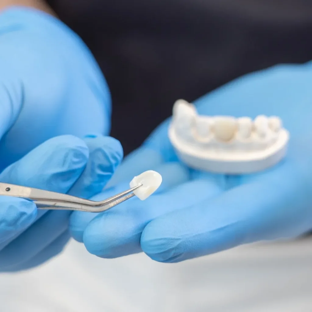 Faccette dentali 11 FACCETTE a Castelfranco Veneto