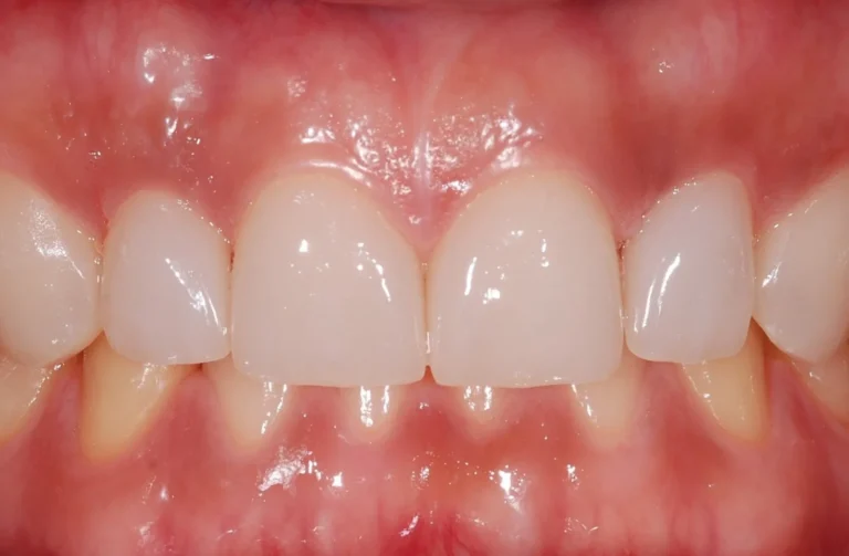 Faccette dentali 38 Faccette - 1 Dopo