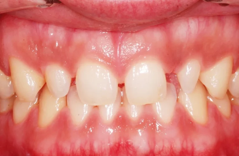 Faccette dentali 37 Faccette - 1 Prima