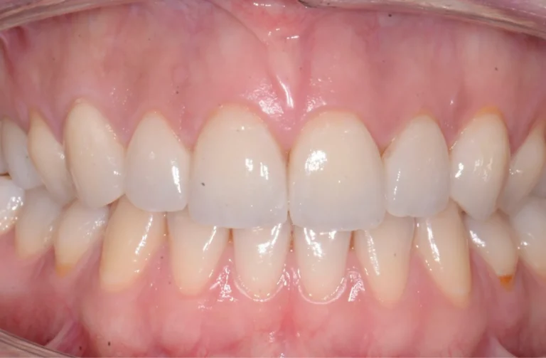 Faccette dentali 40 Faccette - 2 Dopo