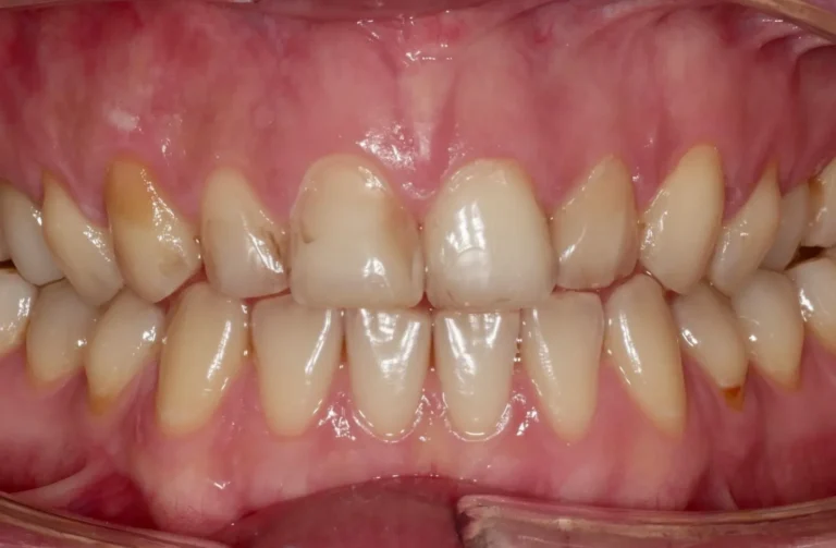 Faccette dentali 39 Faccette - 2 Prima