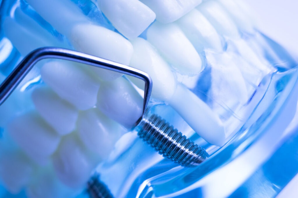 Spiegazione chiara di un impianto dentale: cos'è, come funziona e quando sceglierlo 1 spiegazione chiara di un impianto dentale